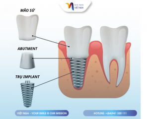 mo-ta-cau-tao-implant