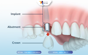 abutment-and-crown-placement-on-dental-implant