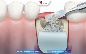 tich-hop-xuong-truoc-khi-trong-implant