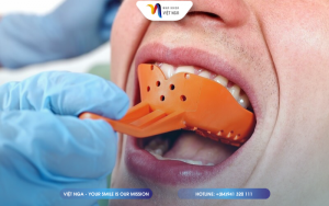 lay-dau-rang-truoc-khi-gan-su-vao-tru-implant