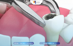 nho-rang-hong-de-trong-implant