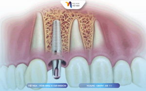 tich-hop-xuong-sau-khi-gan-tru-implant